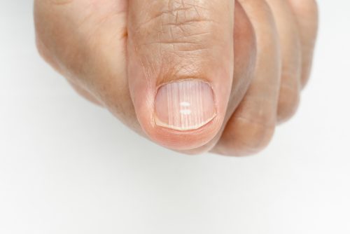Ridgednail